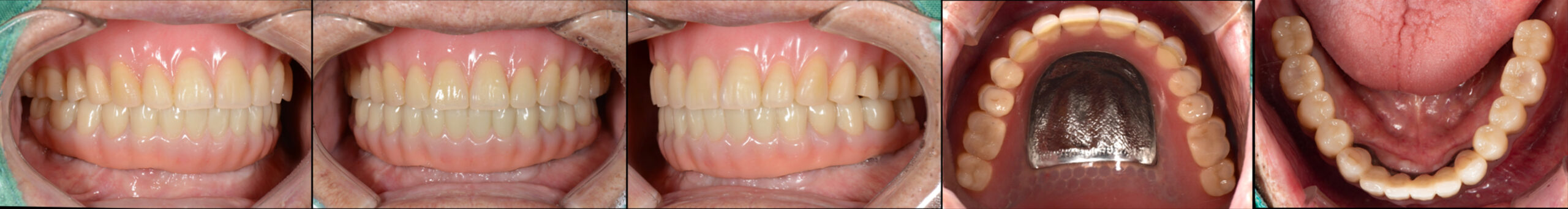 All-on-X Full Zirconia 및 잇몸 Resin-up 완성